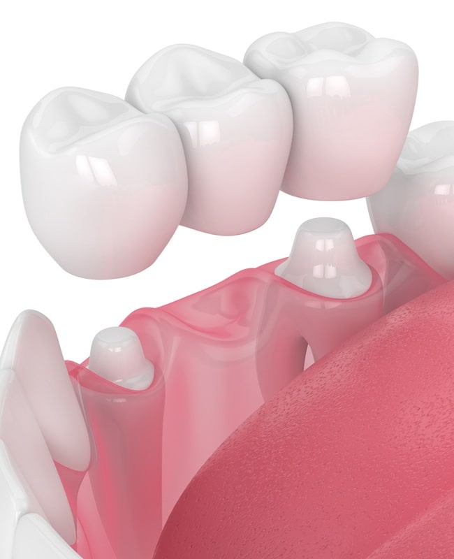 dental-bridge